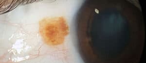 Eye Freckle Removal