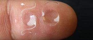 Refractive Lens Exchange (RLE)